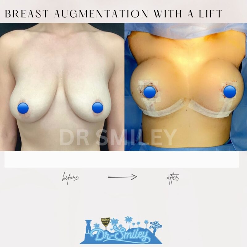 dr smiley top plastic surgeon breast augmentation with lift beverly hills los angeles california 23