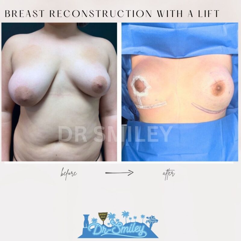 dr smiley top plastic surgeon breast augmentation with lift beverly hills los angeles california 25