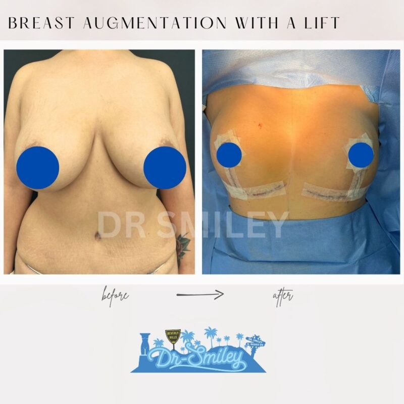 dr smiley top plastic surgeon breast augmentation with lift beverly hills los angeles california 26