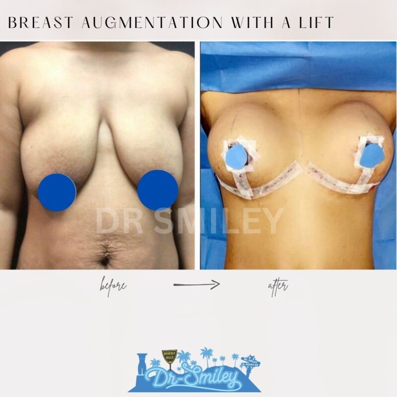 dr smiley top plastic surgeon breast augmentation with lift beverly hills los angeles california 27