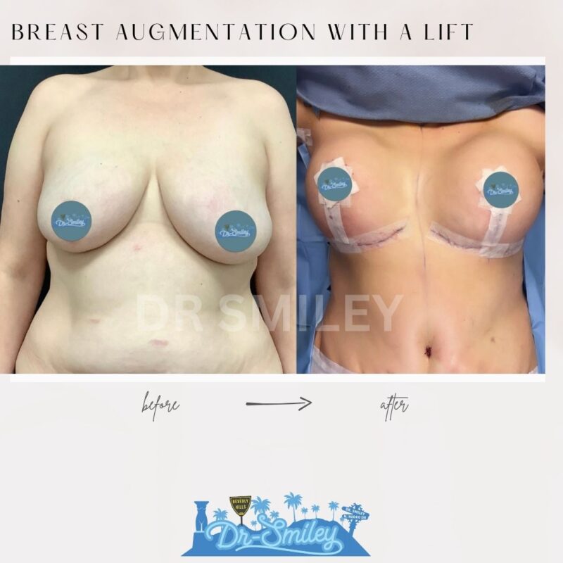 dr smiley top plastic surgeon breast augmentation with lift beverly hills los angeles california 28