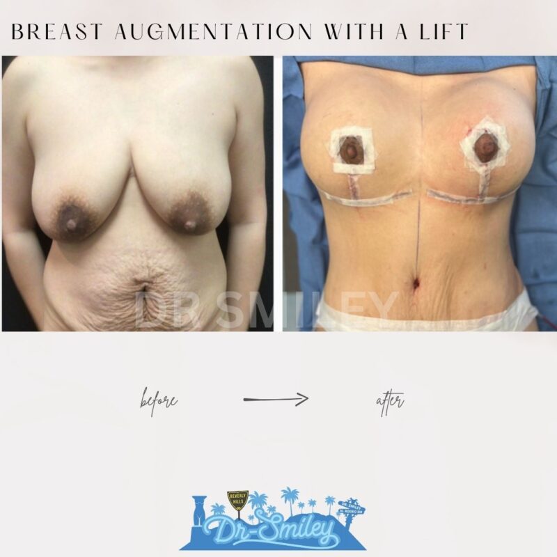 dr smiley top plastic surgeon breast augmentation with lift beverly hills los angeles california 29