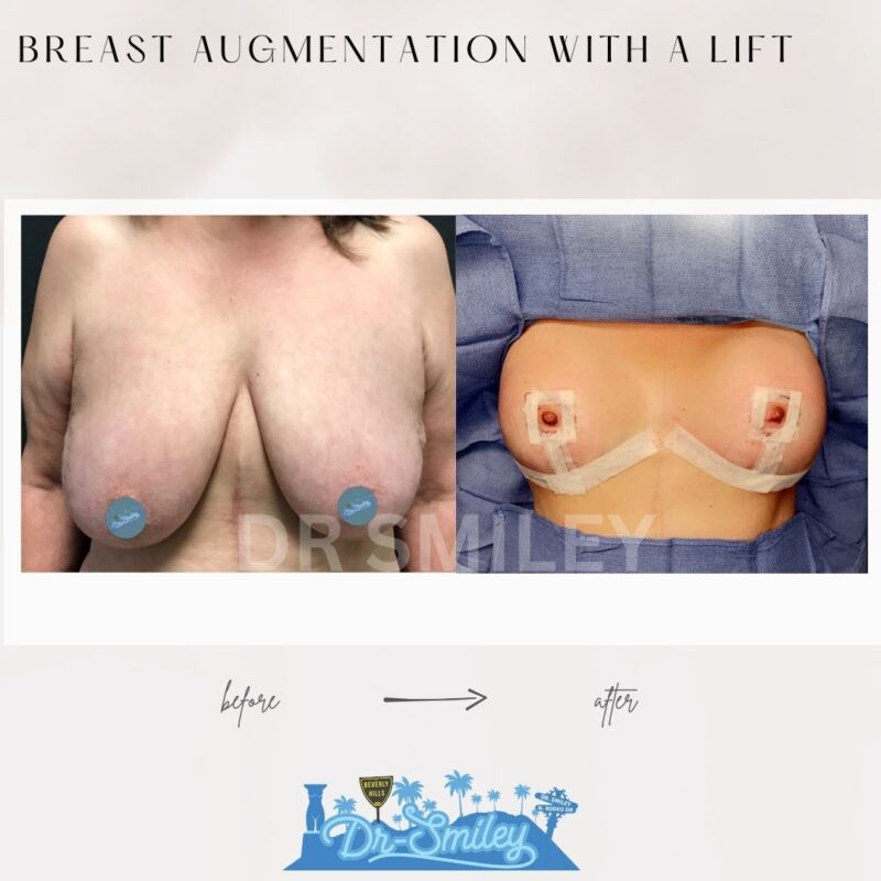 dr smiley top plastic surgeon breast augmentation with lift beverly hills los angeles california 3