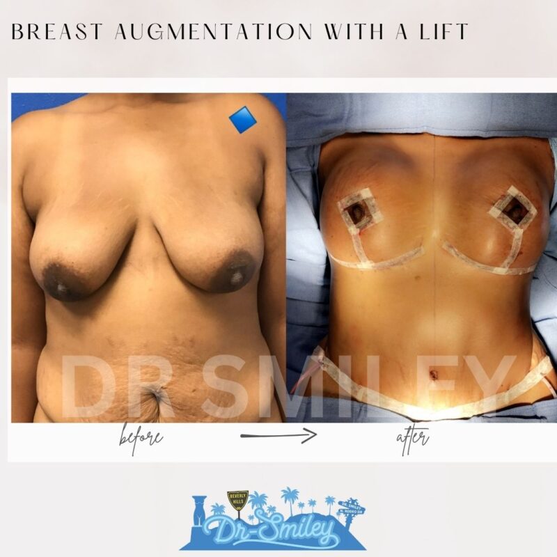 dr smiley top plastic surgeon breast augmentation with lift beverly hills los angeles california 31