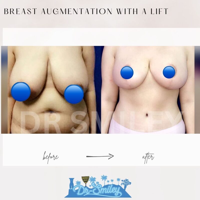 dr smiley top plastic surgeon breast augmentation with lift beverly hills los angeles california 32