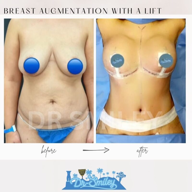 dr smiley top plastic surgeon breast augmentation with lift beverly hills los angeles california 33