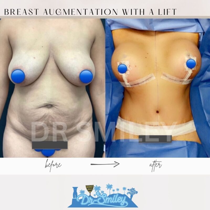 dr smiley top plastic surgeon breast augmentation with lift beverly hills los angeles california 34