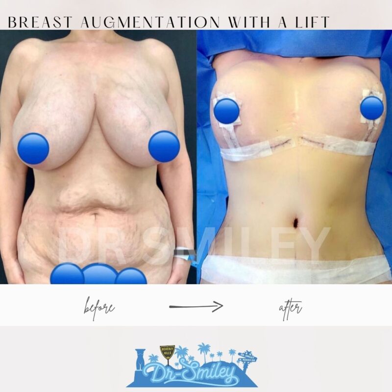 dr smiley top plastic surgeon breast augmentation with lift beverly hills los angeles california 35