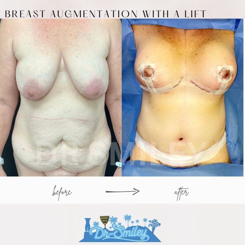 dr smiley top plastic surgeon breast augmentation with lift beverly hills los angeles california 36