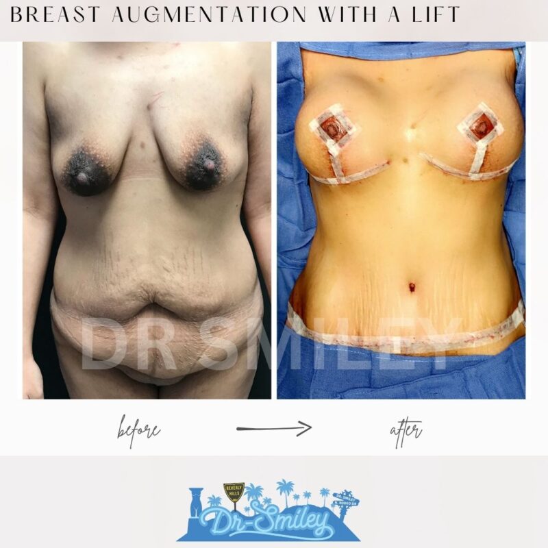 dr smiley top plastic surgeon breast augmentation with lift beverly hills los angeles california 37