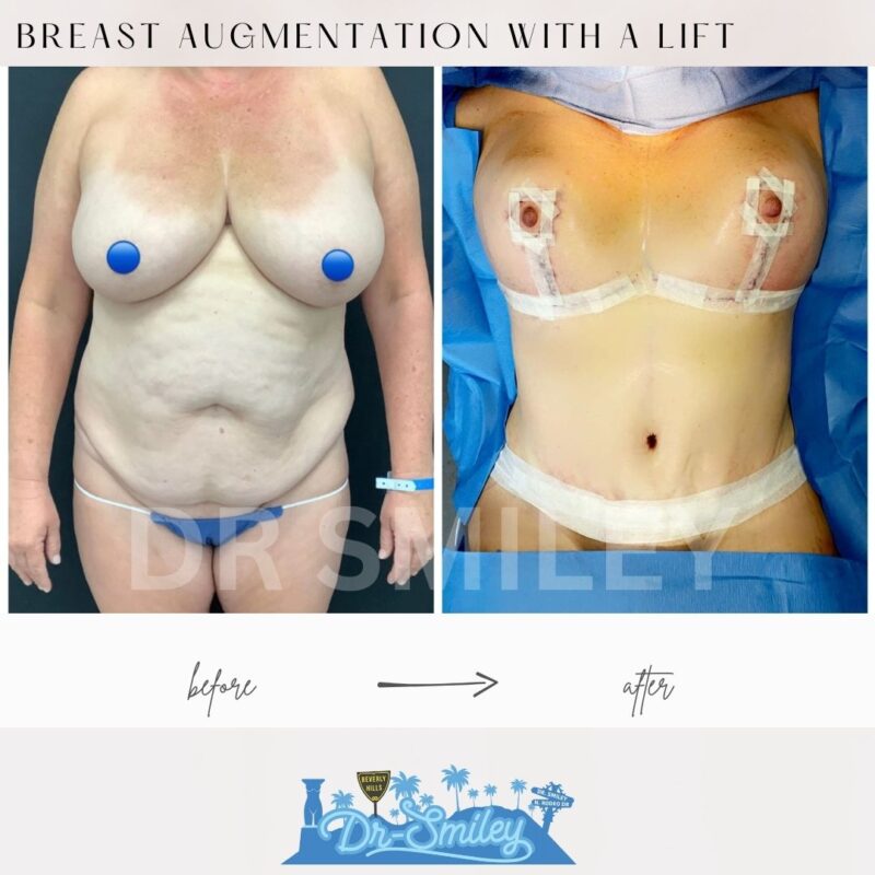 dr smiley top plastic surgeon breast augmentation with lift beverly hills los angeles california 38