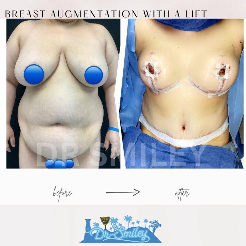 dr smiley top plastic surgeon breast augmentation with lift beverly hills los angeles california 39