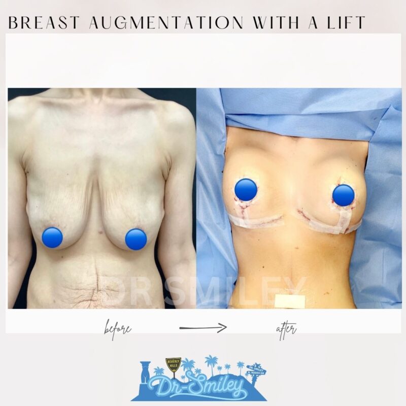 dr smiley top plastic surgeon breast augmentation with lift beverly hills los angeles california 4