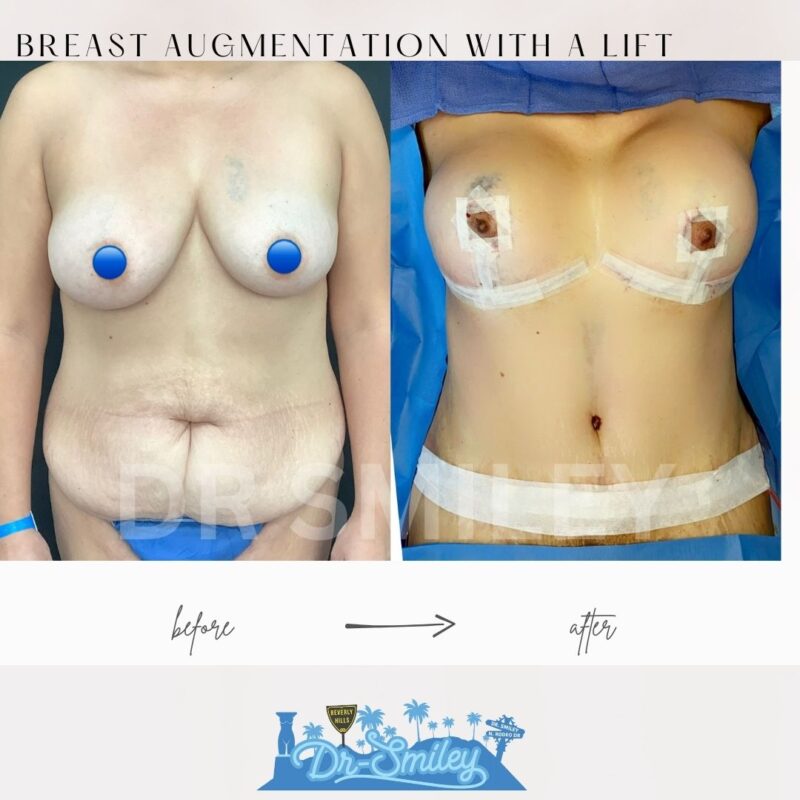 dr smiley top plastic surgeon breast augmentation with lift beverly hills los angeles california 40