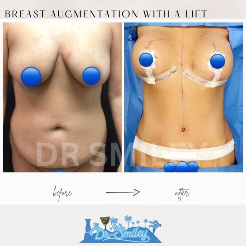 dr smiley top plastic surgeon breast augmentation with lift beverly hills los angeles california 41