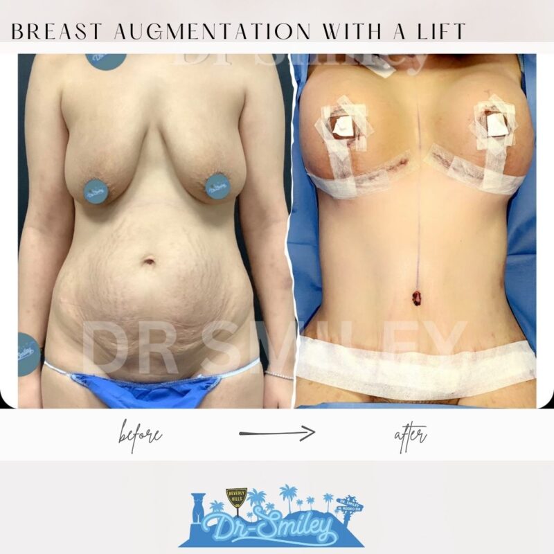 dr smiley top plastic surgeon breast augmentation with lift beverly hills los angeles california 42