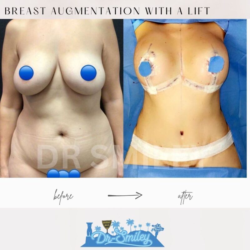 dr smiley top plastic surgeon breast augmentation with lift beverly hills los angeles california 43