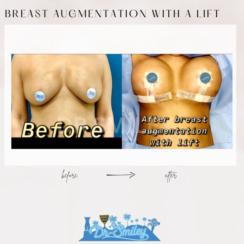 dr smiley top plastic surgeon breast augmentation with lift beverly hills los angeles california 7