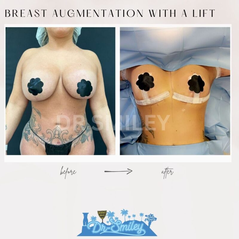 dr smiley top plastic surgeon breast augmentation with lift beverly hills los angeles california 8