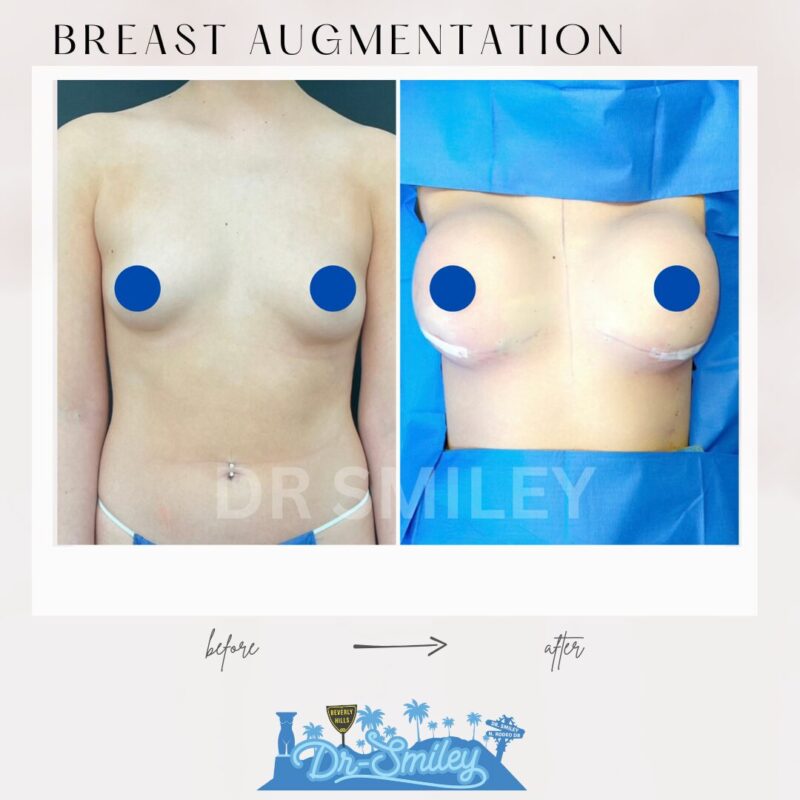 dr smiley top plastic surgeon breast augmentation. los angeles california 1