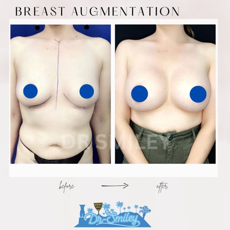 dr smiley top plastic surgeon breast augmentation. los angeles california 11