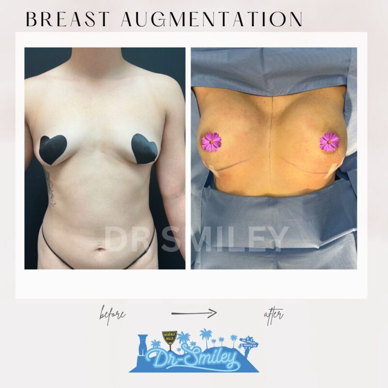 dr smiley top plastic surgeon breast augmentation. los angeles california 12