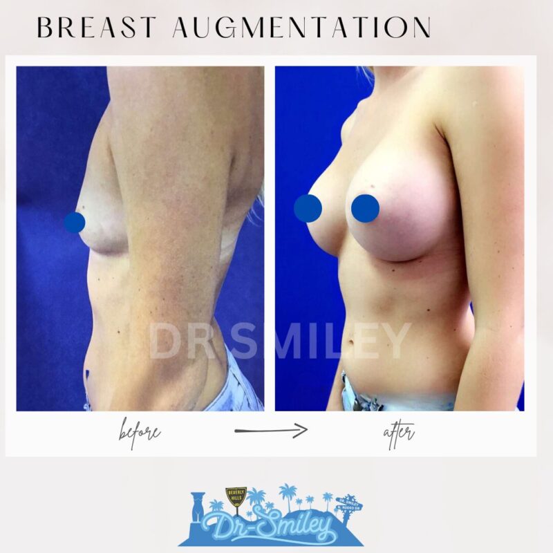 dr smiley top plastic surgeon breast augmentation. los angeles california 13