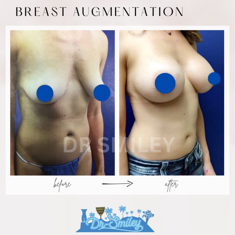 dr smiley top plastic surgeon breast augmentation. los angeles california 14