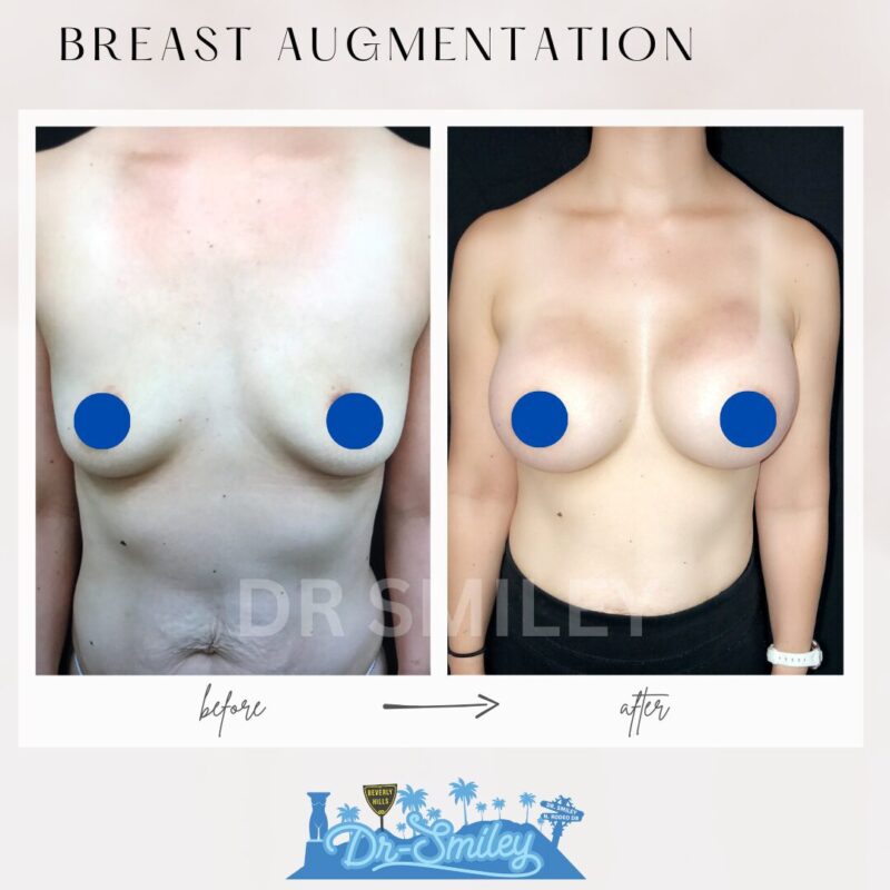 dr smiley top plastic surgeon breast augmentation. los angeles california 15