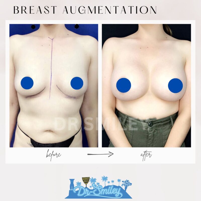 dr smiley top plastic surgeon breast augmentation. los angeles california 16