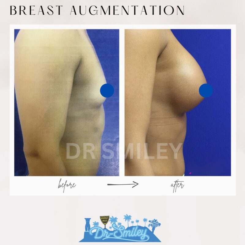 dr smiley top plastic surgeon breast augmentation. los angeles california 17