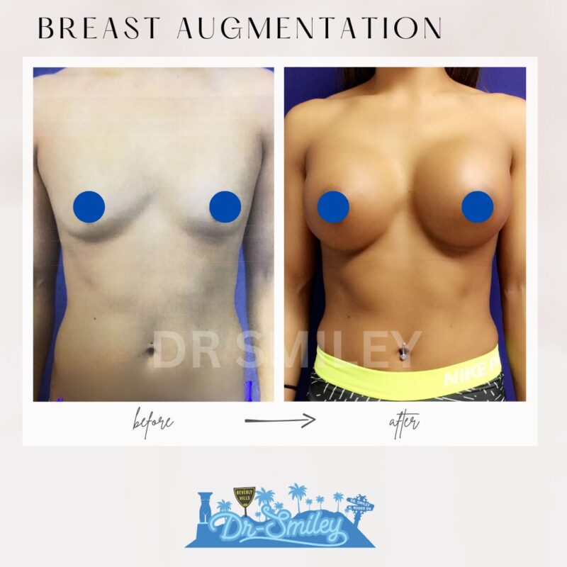 dr smiley top plastic surgeon breast augmentation. los angeles california 18