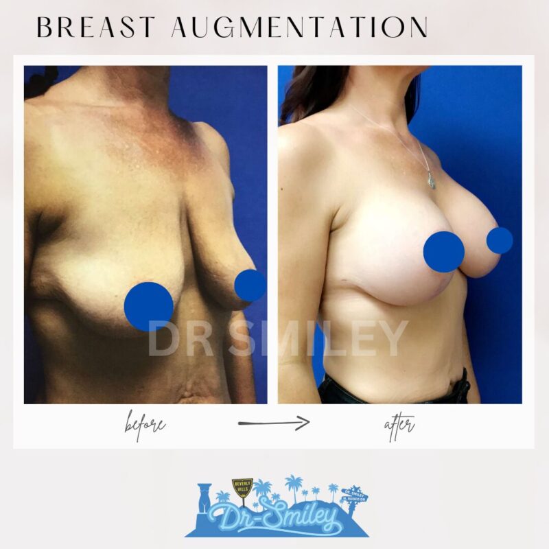 dr smiley top plastic surgeon breast augmentation. los angeles california 19