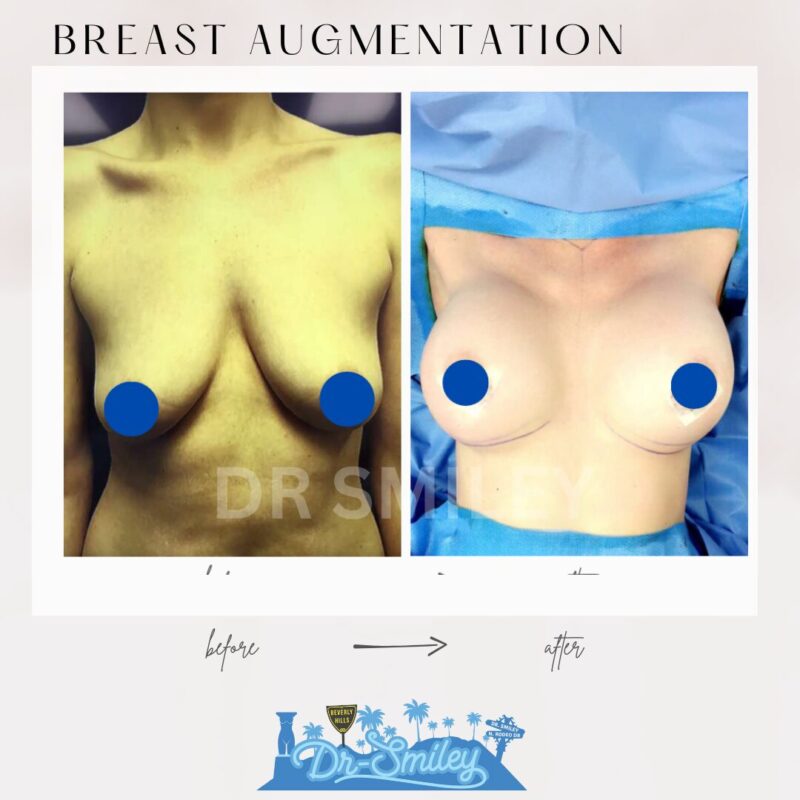 dr smiley top plastic surgeon breast augmentation. los angeles california 2