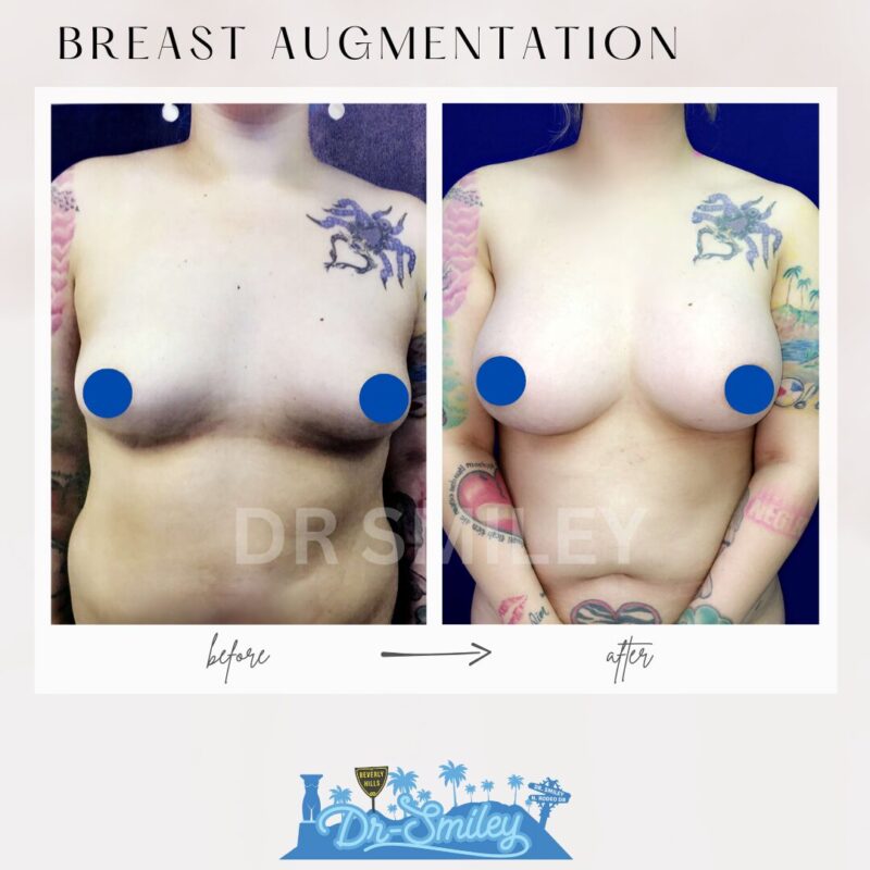 dr smiley top plastic surgeon breast augmentation. los angeles california 20