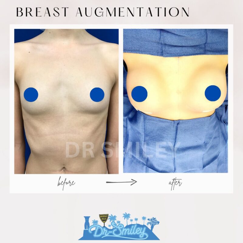 dr smiley top plastic surgeon breast augmentation. los angeles california 25