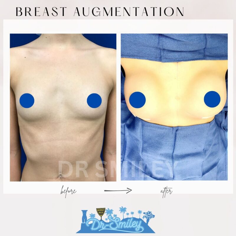 dr smiley top plastic surgeon breast augmentation. los angeles california 4