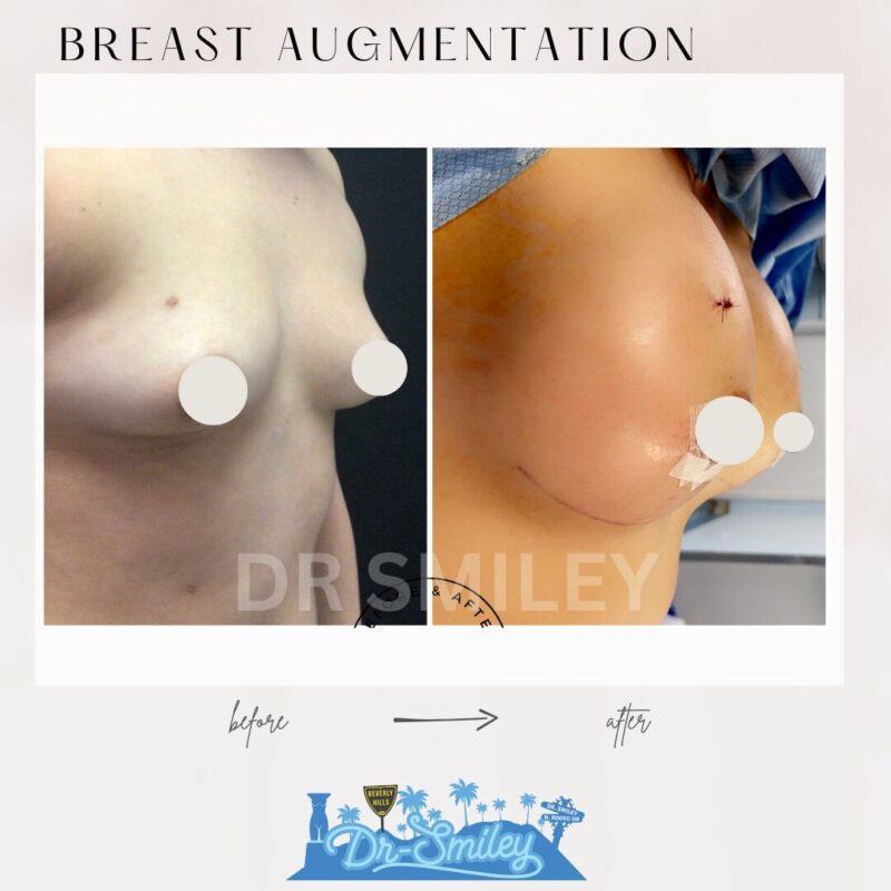 dr smiley top plastic surgeon breast augmentation. los angeles california 5