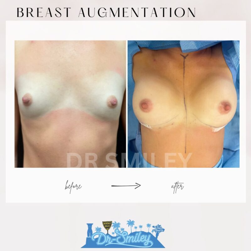 dr smiley top plastic surgeon breast augmentation. los angeles california 6