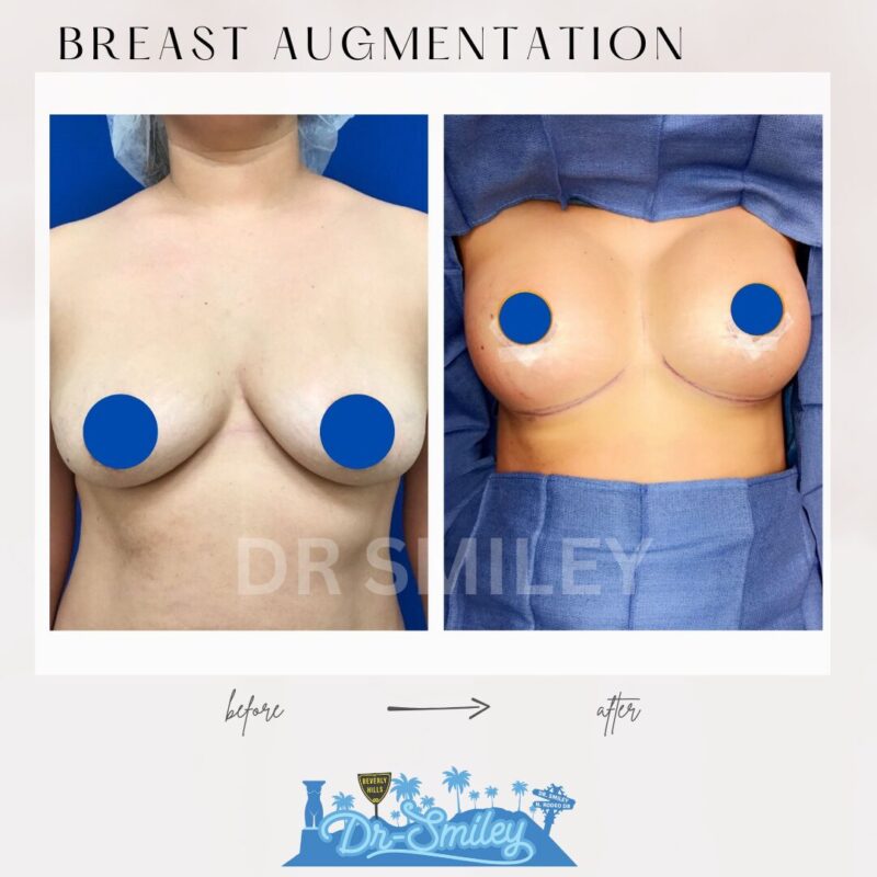 dr smiley top plastic surgeon breast augmentation. los angeles california 7