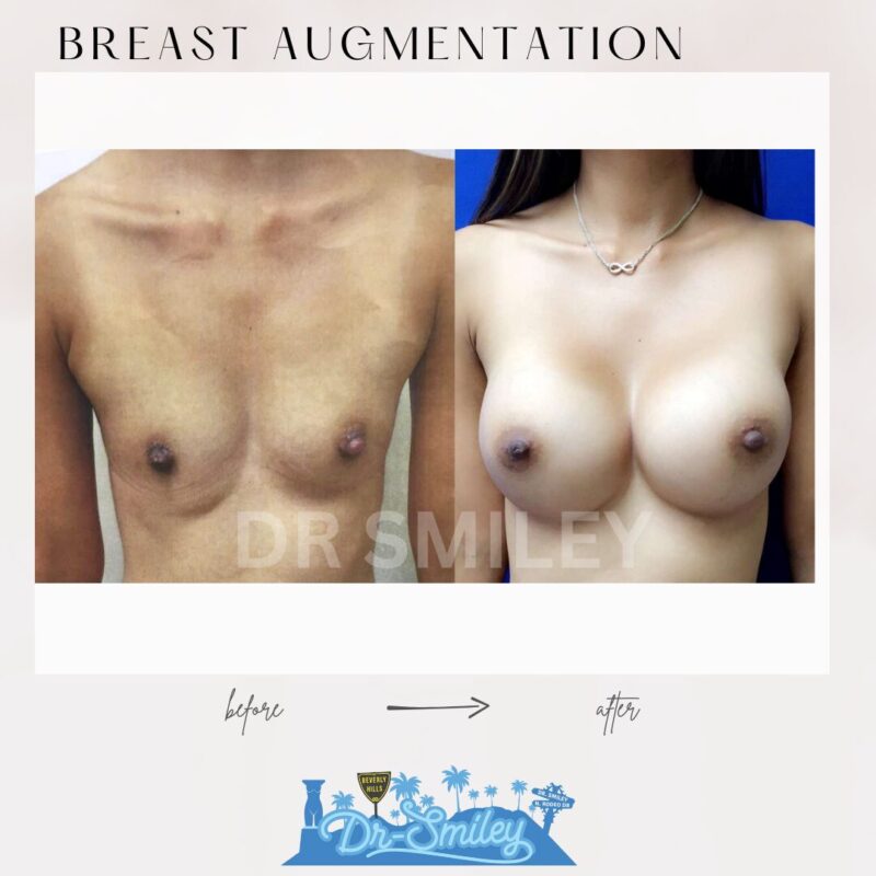 dr smiley top plastic surgeon breast augmentation. los angeles california 8