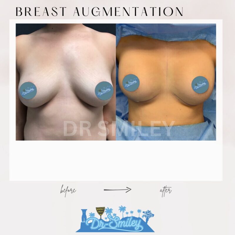 dr smiley top plastic surgeon breast augmentation. los angeles california 9