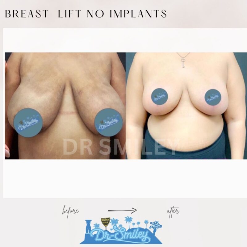 dr smiley top plastic surgeon breast lift beverly hills los angeles california 1