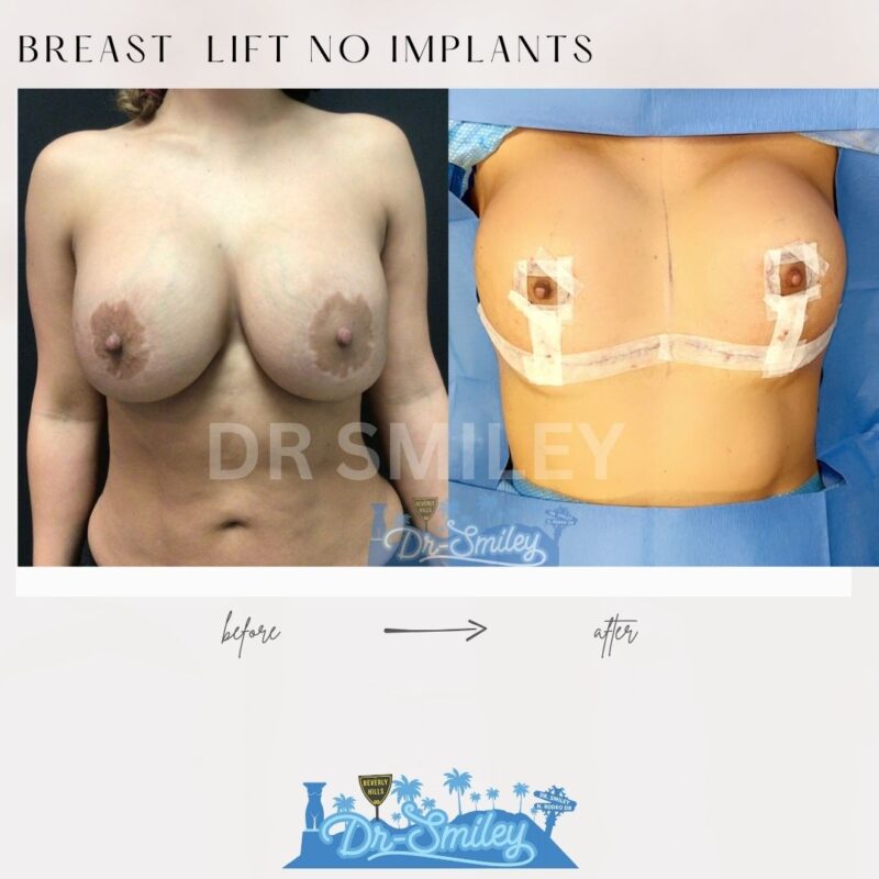 dr smiley top plastic surgeon breast lift beverly hills los angeles california 10