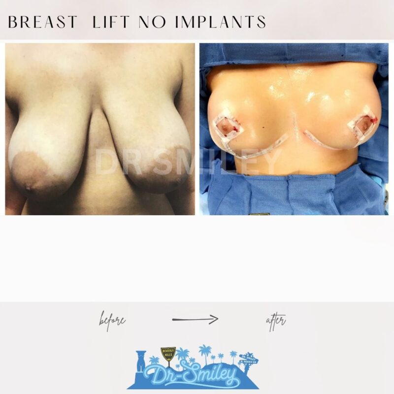 dr smiley top plastic surgeon breast lift beverly hills los angeles california 11