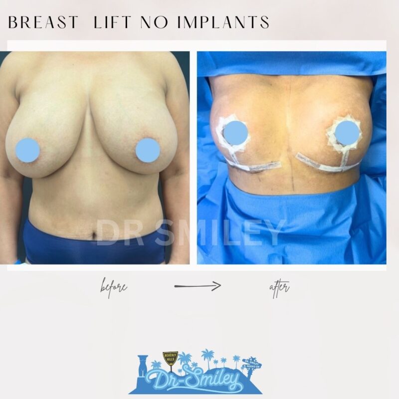 dr smiley top plastic surgeon breast lift beverly hills los angeles california 12