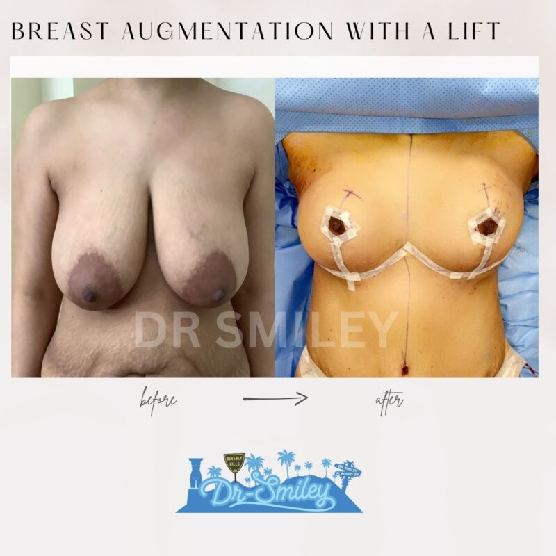 dr smiley top plastic surgeon breast lift beverly hills los angeles california 14