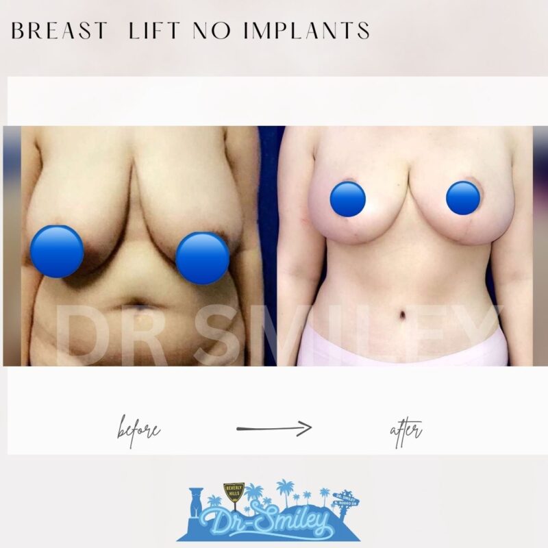 dr smiley top plastic surgeon breast lift beverly hills los angeles california 18