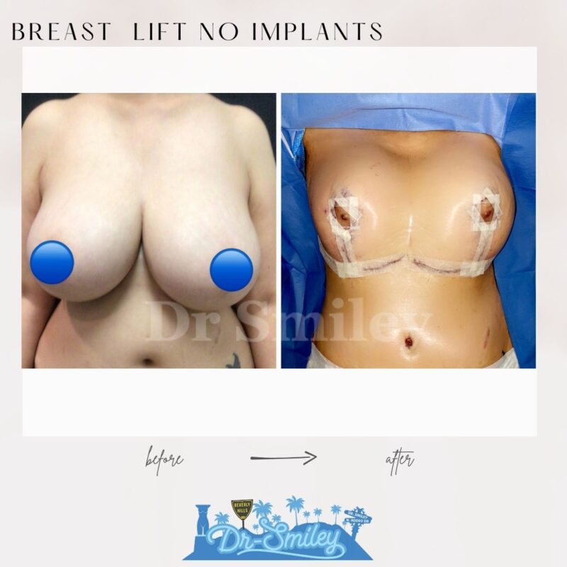 dr smiley top plastic surgeon breast lift beverly hills los angeles california 2