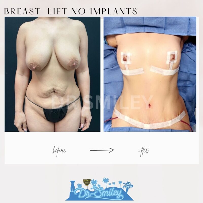 dr smiley top plastic surgeon breast lift beverly hills los angeles california 6